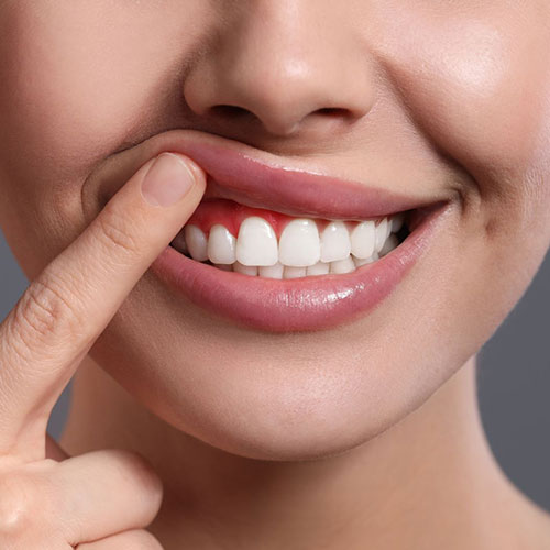 Image of inflamed gums